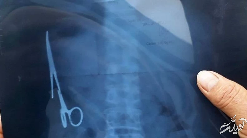 پیدا شدن یک کیلو پیچ و مهره در شکم بیمار اورژانسی پیدا شدن یک کیلو پیچ و مهره در شکم بیمار اورژانسی